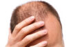 Non-Surgical-Hair-Replacement-