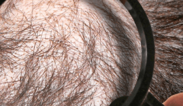 Top reasons and solutions for men to get rid of hair thinning at crown!