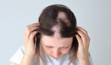 Alopecia and its risk factors