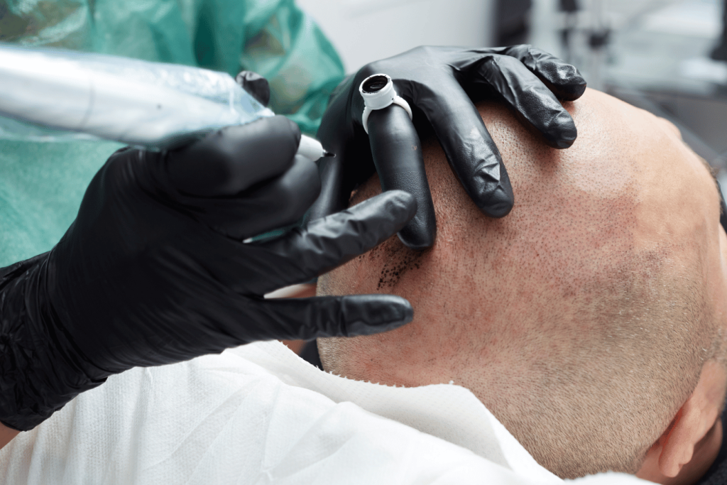 Micro scalp pigmentation treatment