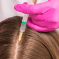 PRP Hair Treatment in Dubai – The Best Solution for Hair Thinning