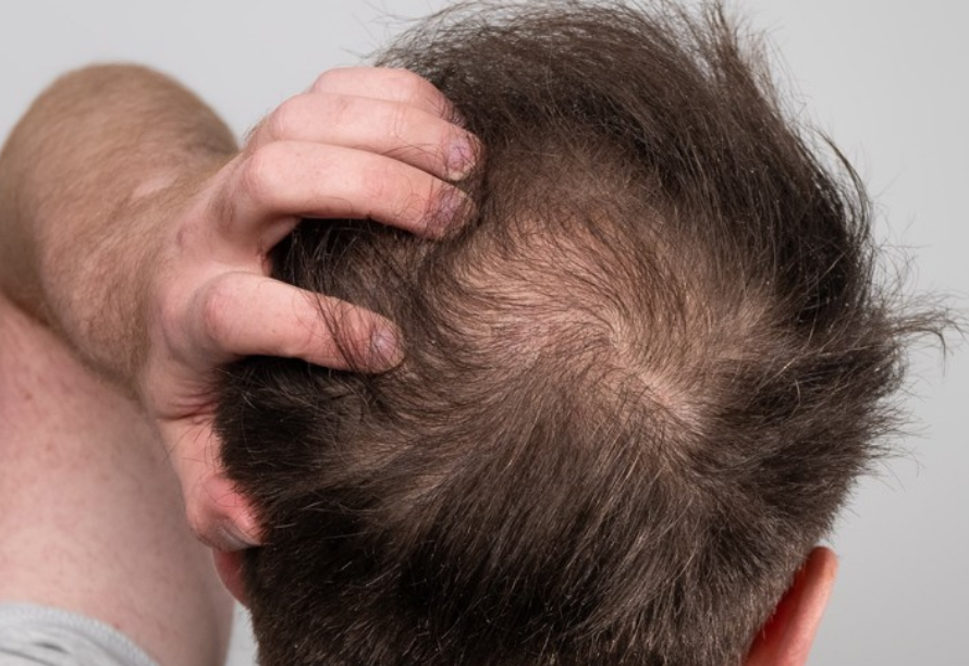 Hair Thinning