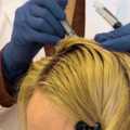 Scalp Microneedling Benefits: Does It Really Help Hair Growth & Thickness?