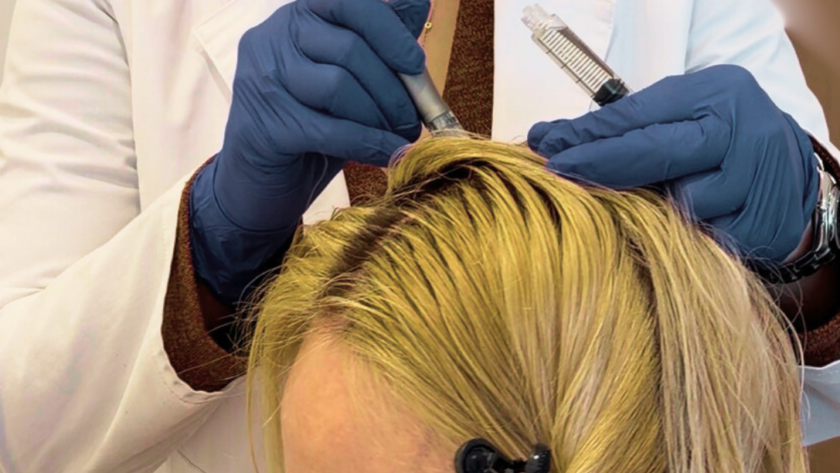 SCALP MICRONEEDLING (1)