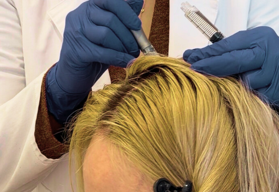 SCALP MICRONEEDLING (1)