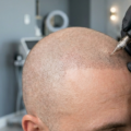 SMP Treatment for Bald Spots: How Scalp Micropigmentation Creates Fuller Hair Instantly