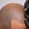 Top-Rated SMP Clinic UAE: Why Scalp Micropigmentation Is Transforming Hair Restoration