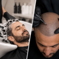 4 Hair Growth Treatments in Dubai: Options, Benefits & What to Expect
